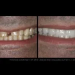 Before & after dental treatment