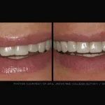 Before & after dental treatment