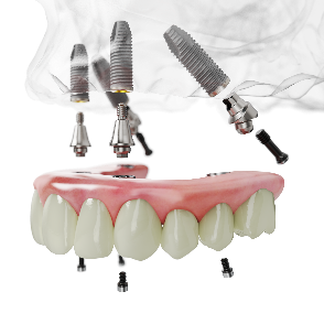 Digital illustration of the All-on-4 treatment concept