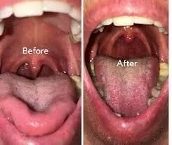before and after Nightlase treatment