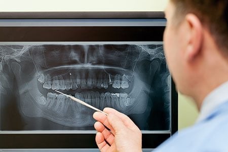 mouth X-ray