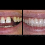 Before & after dental treatment