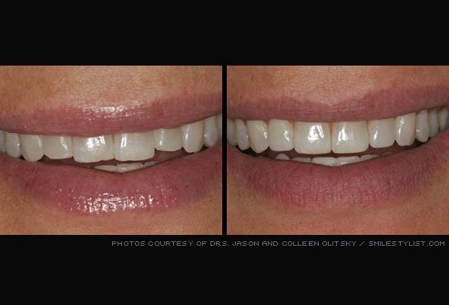 Before & after dental treatment