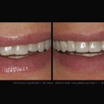 Before & after dental treatment