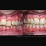 Before & after dental treatment