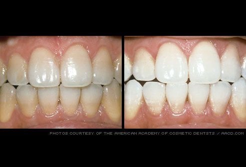 Before & after dental treatment