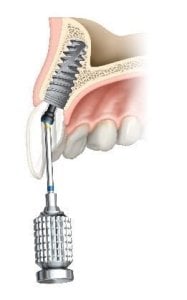 Digital illustration of a dental implant being placed in the upper jaw